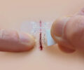 micromend emergency wound closures